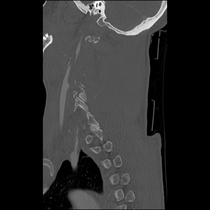 Bilateral perched facets with cord injury (Radiopaedia 45587-49713 Sagittal bone window 41).jpg