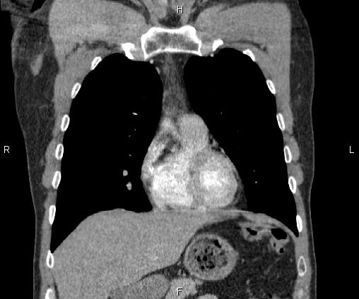 Bilateral pulmonary AVM (Radiopaedia 83134-97505 C 25).jpg