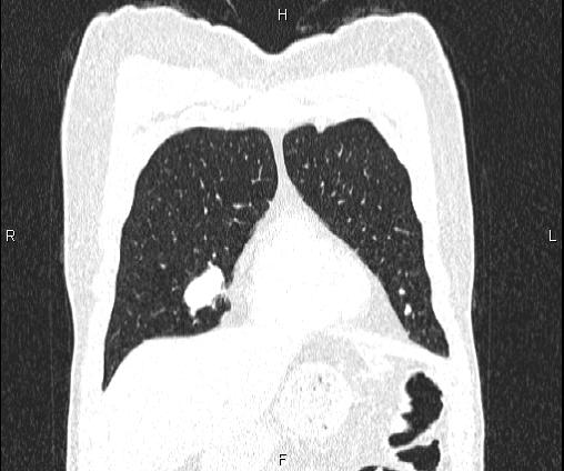 Bilateral pulmonary AVM (Radiopaedia 83134-97505 Coronal lung window 23).jpg
