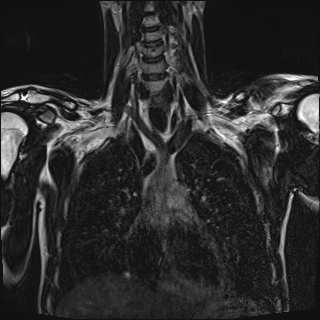 Bilateral spinoglenoid notch ganglion cysts (Radiopaedia 29577-30082 Coronal T2 46).jpg
