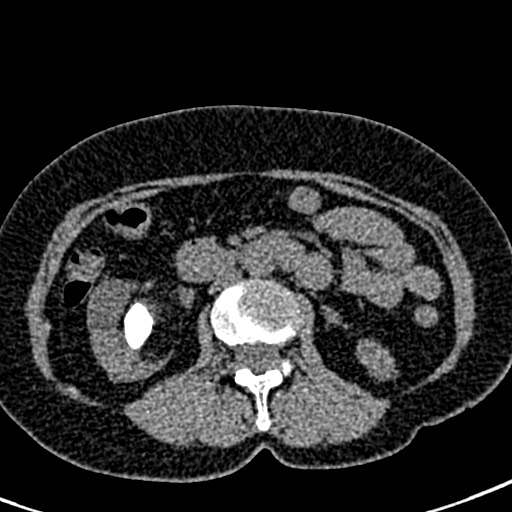 Bilateral staghorn calculi (Radiopaedia 59475-66842 Axial non-contrast 29).jpg