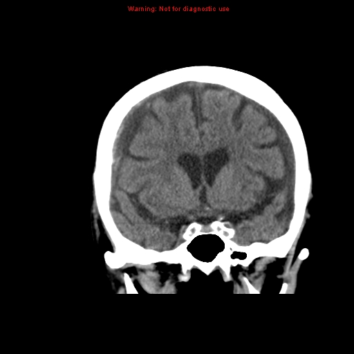 File:Bilateral subdural hemorrhage (Radiopaedia 8819-9620 Coronal non-contrast 1).jpg