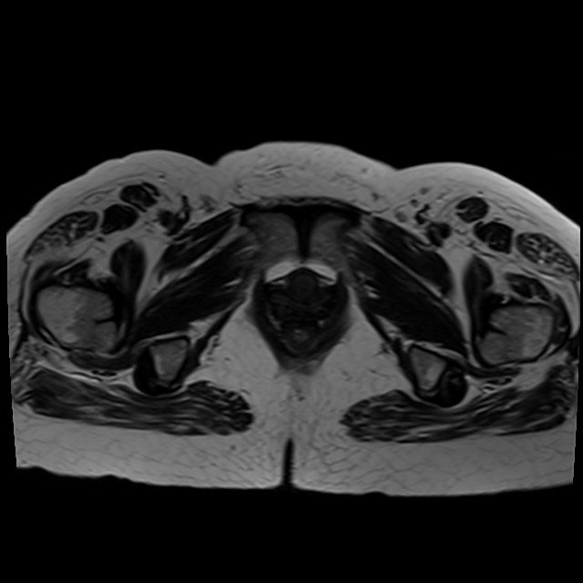 Bilateral tubo-ovarian abscesses (Radiopaedia 58635-65829 Axial T2 43).jpg