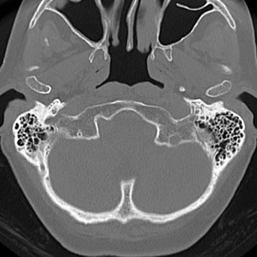 File:Bilateral tympanoplasty (Radiopaedia 16947-16664 Axial bone window 28).jpg