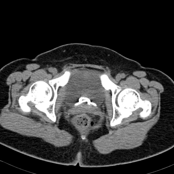 Bilateral ureteric stents (Radiopaedia 48795-53825 Axial non-contrast 66).jpg