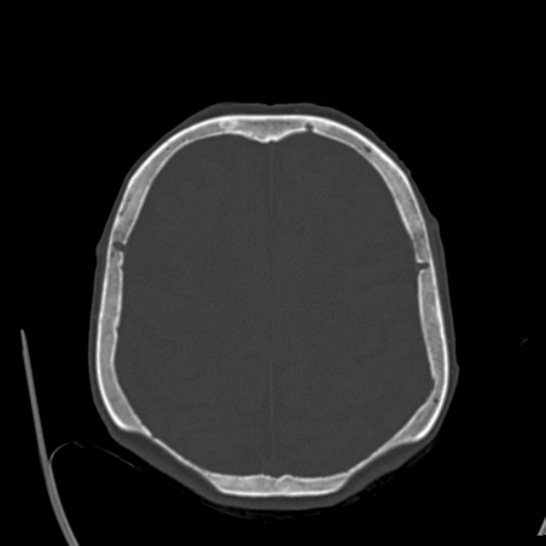 Biparietal osteodystrophy (Radiopaedia 46109-50463 bone window 47).jpg