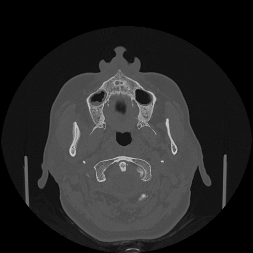 File:Bisphosphonate-related osteonecrosis of the jaw (Radiopaedia 71324-81642 Axial bone window 117).jpg