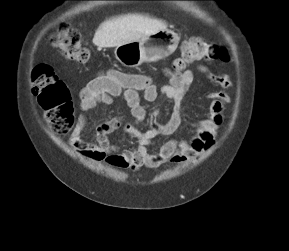 Bladder papillary urothelial carcinoma (Radiopaedia 48119-52951 C 14).png