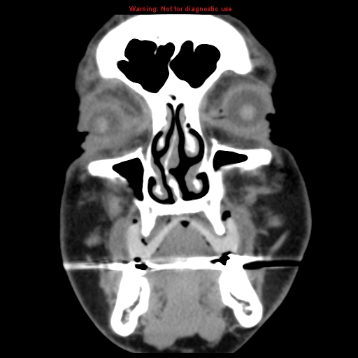 File:Blowout fracture with inferior rectus entrapment (Radiopaedia 12418-12673 Coronal non-contrast 1).jpg