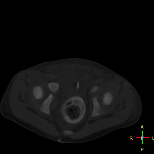 File:Blunt abdominal trauma (Radiopaedia 24780-25044 Axial bone window 16).jpg