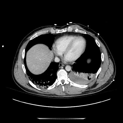 Blunt abdominal trauma with solid organ and musculoskelatal injury with active extravasation (Radiopaedia 68364-77895 A 8).jpg