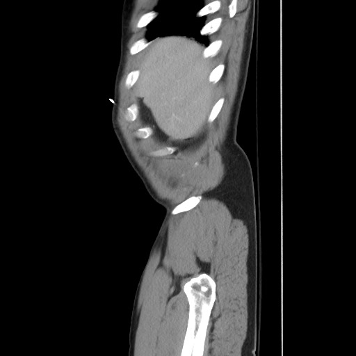 File:Blunt abdominal trauma with solid organ and musculoskelatal injury with active extravasation (Radiopaedia 68364-77895 C 26).jpg