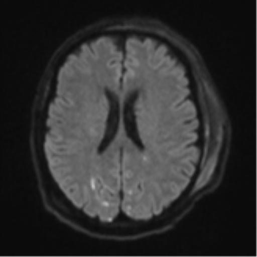 Blunt cerebrovascular injury (Radiopaedia 53682-59745 Axial DWI 49).png