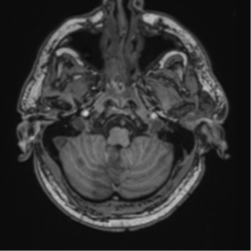 File:Blunt cerebrovascular injury (Radiopaedia 53682-59745 Axial T1 6).png