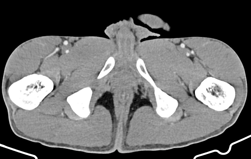 Blunt injury to the small bowel (Radiopaedia 74953-85987 A 207).jpg