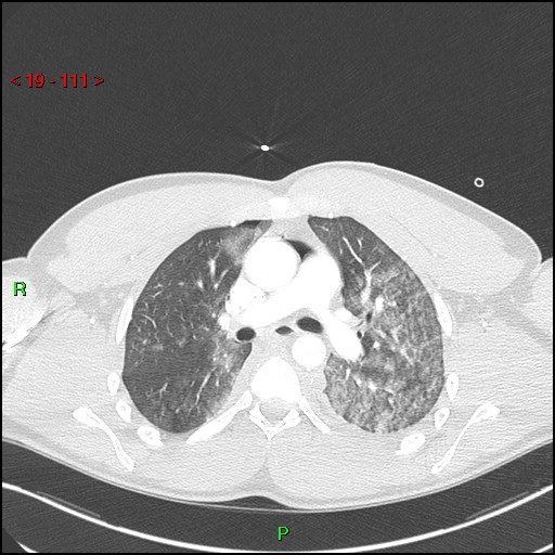 File:Blunt thoracic trauma (Radiopaedia 73454-84221 Axial lung window 41).jpg