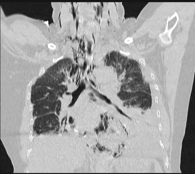 Boerhaave syndrome (Radiopaedia 45644-49799 Coronal lung window 38).jpg