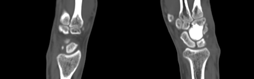 Bone islands - carpus (Radiopaedia 63141-71658 Coronal bone window 28).jpg