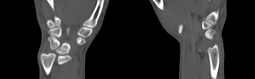 Bone islands - carpus (Radiopaedia 63141-71658 Coronal bone window 53).jpg
