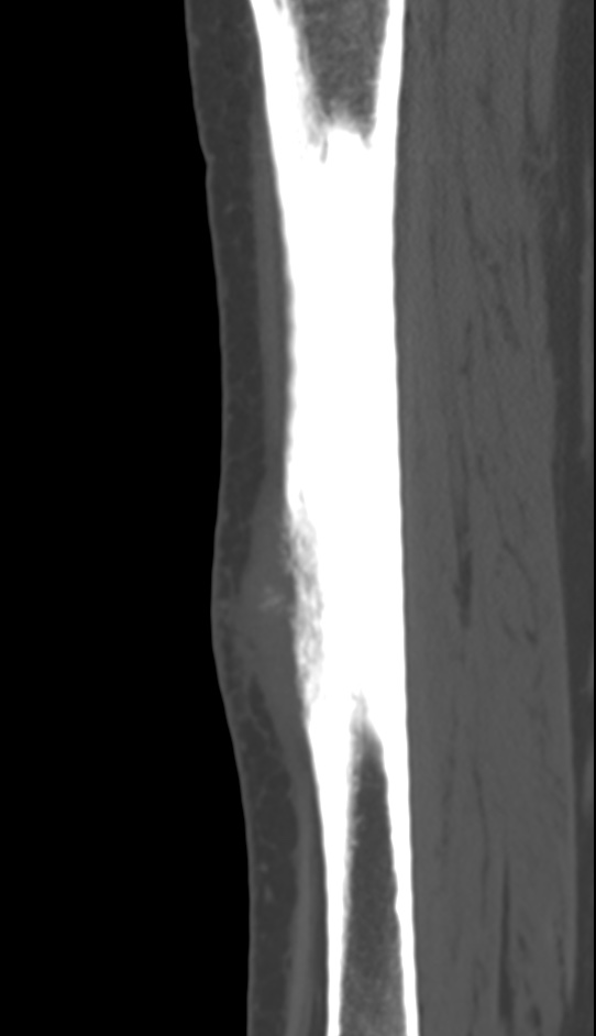 Bone metastasis - tibia (Radiopaedia 57665-64609 Sagittal bone window 100).jpg