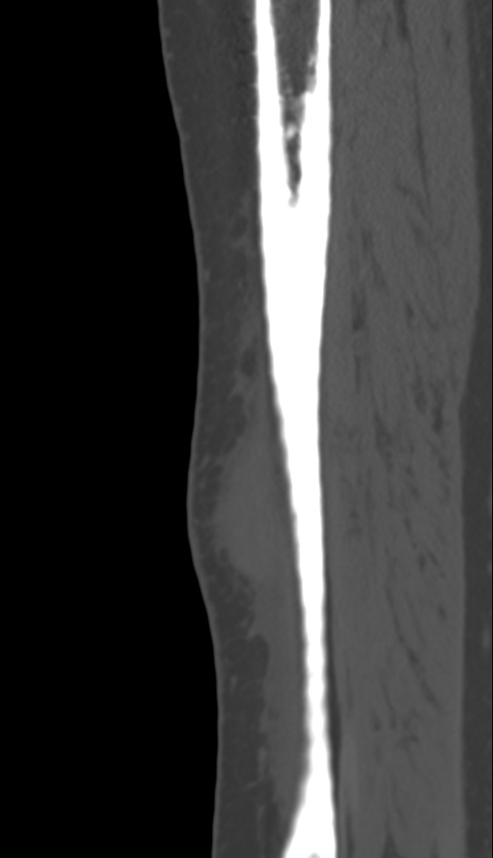 Bone metastasis - tibia (Radiopaedia 57665-64609 Sagittal bone window 43).jpg