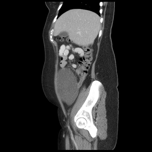 File:Borderline mucinous tumor (ovary) (Radiopaedia 78228-90808 B 19).jpg