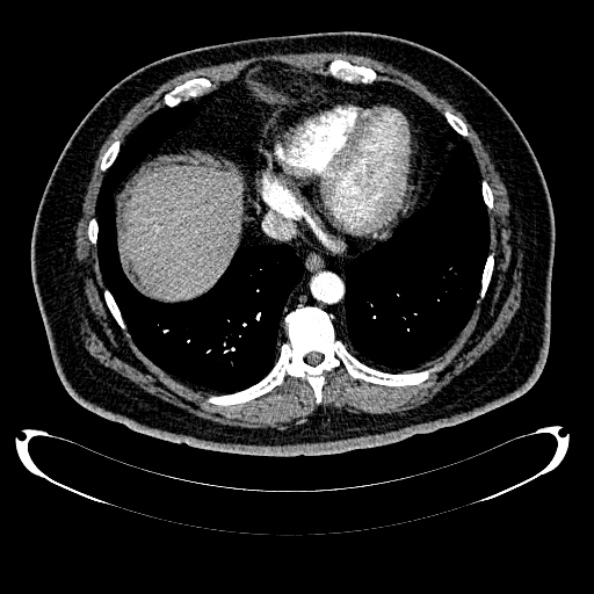 Bosniak renal cyst - type IV (Radiopaedia 24244-24518 B 13).jpg