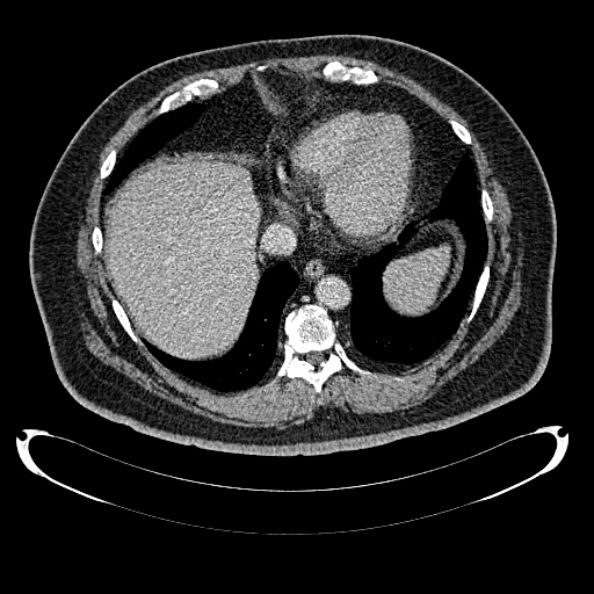File:Bosniak renal cyst - type IV (Radiopaedia 24244-24518 C 17).jpg