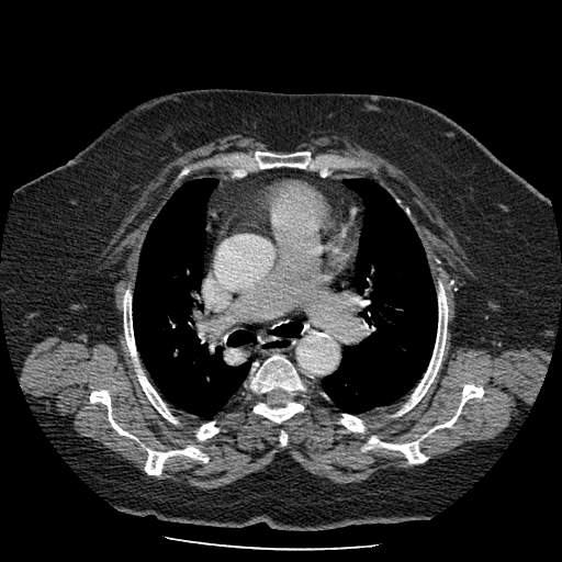 Bovine aortic arch - right internal mammary vein drains into the superior vena cava (Radiopaedia 63296-71875 A 60).jpg