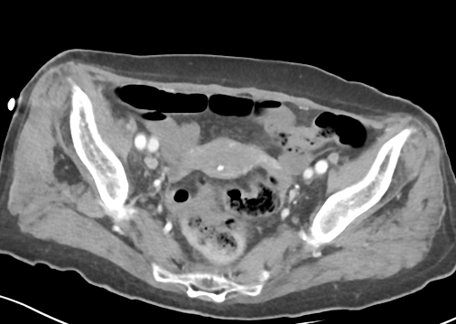 File:Bowel ischemia (Radiopaedia 58273-65382 A 53).png