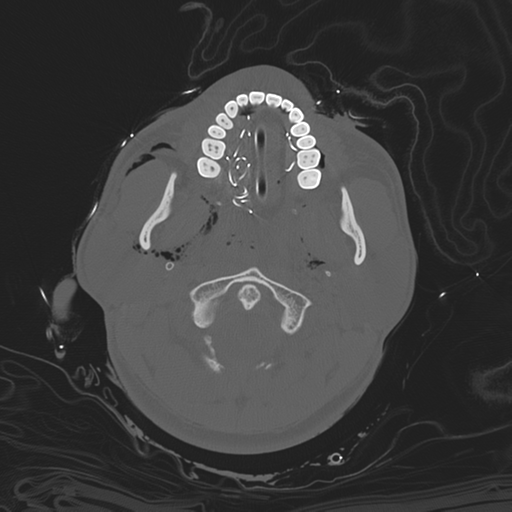 File:Brain contusions, internal carotid artery dissection and base of skull fracture (Radiopaedia 34089-35339 Axial bone window 36).png