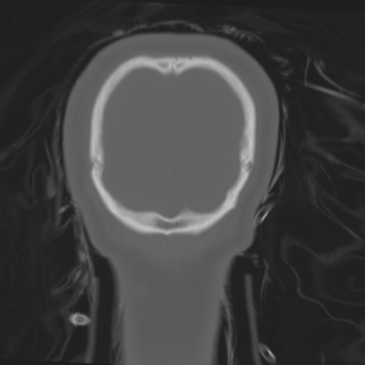 Brain contusions, internal carotid artery dissection and base of skull fracture (Radiopaedia 34089-35339 Coronal bone window 64).png