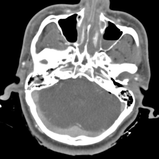 Brain contusions, internal carotid artery dissection and base of skull fracture (Radiopaedia 34089-35339 D 42).png