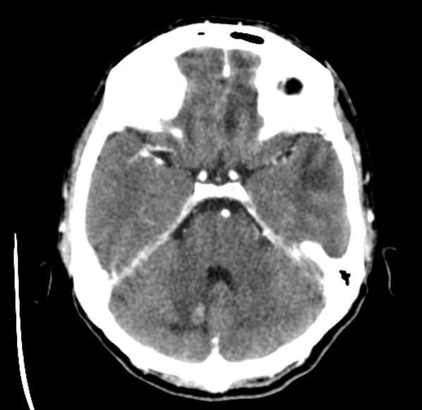 File:Brain metastases from lung cancer (Radiopaedia 24480-24781 Axial C+ delayed 16).jpg