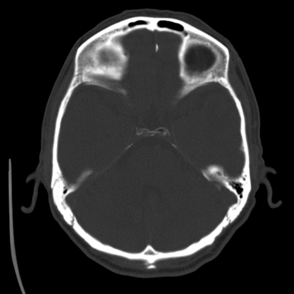 Brain metastases from lung cancer (Radiopaedia 24480-24781 Axial bone window 14).jpg