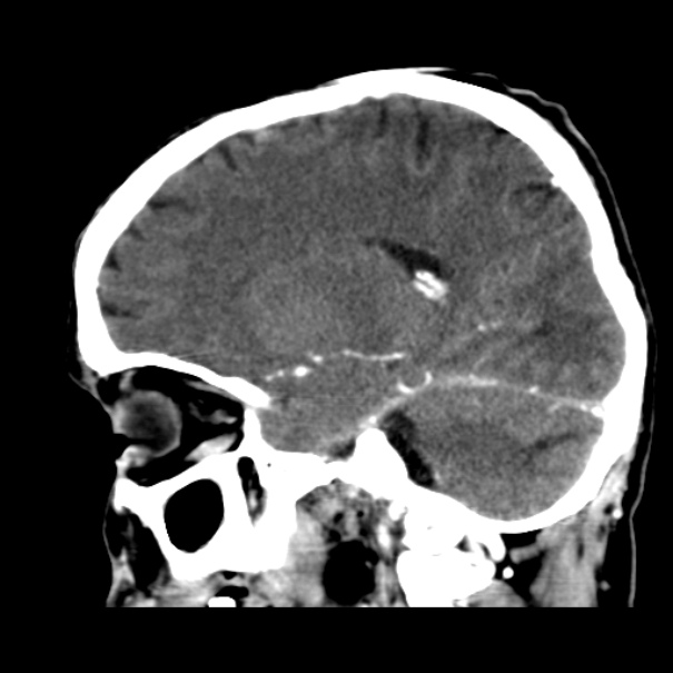 Brain metastases from lung cancer (Radiopaedia 24480-24781 C+ delayed 22).jpg