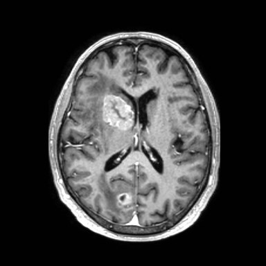 Brain metastases from lung cancer (Radiopaedia 83839-99028 Axial T1 C+ 37).jpg