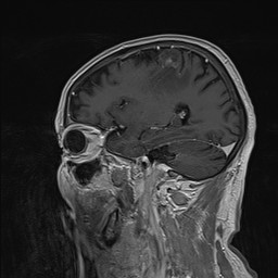 Brain metastasis (Radiopaedia 42617-45761 Sagittal T1 C+ 31).jpg