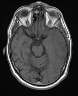 File:Brain metastasis (large cystic mass) (Radiopaedia 47497-52107 Axial T1 10).png