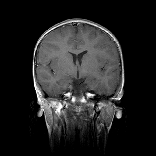 File:Brainstem ganglioglioma (Radiopaedia 10763-11224 Coronal T1 C+ 11).jpg
