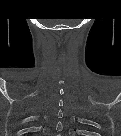 Branchial cleft cyst (Radiopaedia 31167-31875 Coronal bone window 54).jpg