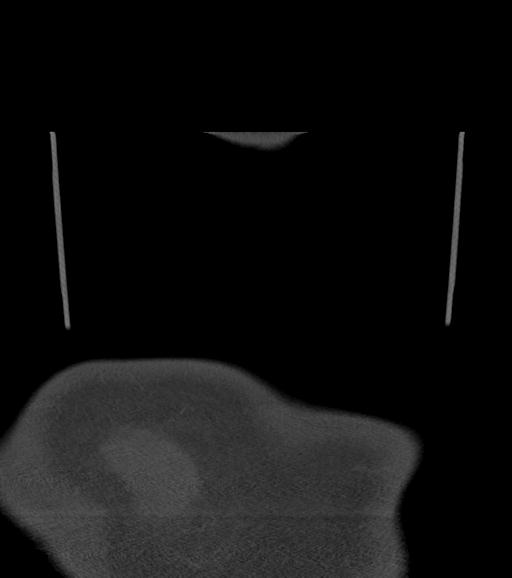 Branchial cleft cyst (Radiopaedia 31167-31875 Coronal bone window 71).jpg