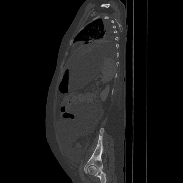 Breast cancer metastases - hepatic and skeletal (Radiopaedia 34201-35461 Sagittal bone window 71).jpg