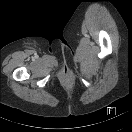 File:Breast metastases from renal cell cancer (Radiopaedia 79220-92225 C 135).jpg