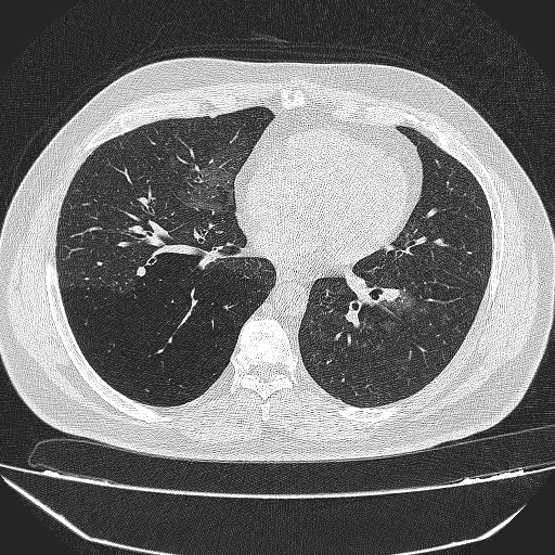 File:Bronchial atresia (Radiopaedia 58271-65417 Axial lung window 30).jpg