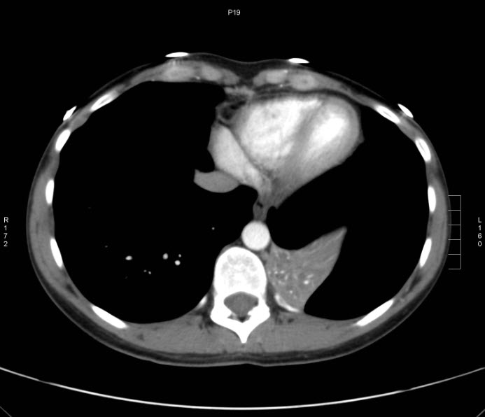 File:Bronchial carcinoid tumor (Radiopaedia 15042-42507 B 10).jpg
