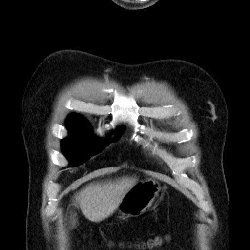 Bronchial carcinoid tumor (Radiopaedia 67377-76764 C 17).jpg