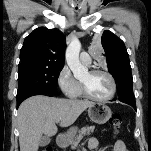 Bronchial carcinoid tumor (Radiopaedia 67377-76764 C 29).jpg