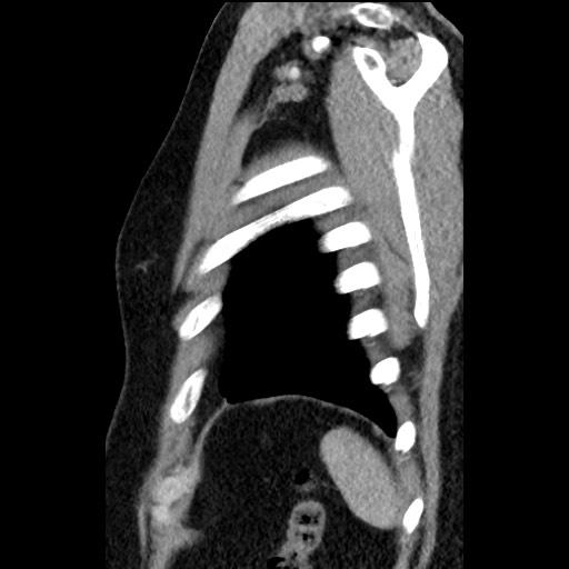 Bronchial carcinoid tumor (Radiopaedia 67377-76764 E 62).jpg