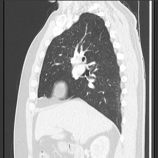 Bronchial carcinoid tumor (Radiopaedia 67377-76764 Sagittal lung window 27).jpg